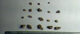 Drug abuse and kidney stones