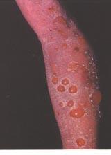 Drug allergy deaths