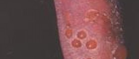 Drug allergy facts