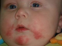 Dry skin conditions in children | Children's & Teens Health articles ...