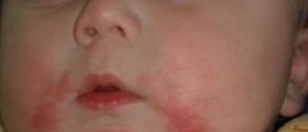 Dry skin conditions in children