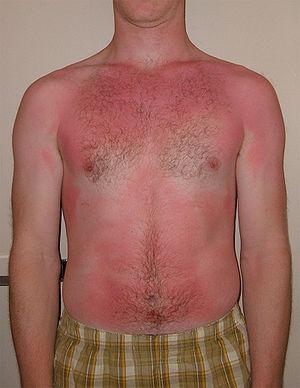 Dry skin from sunburn