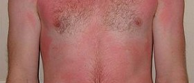 Dry skin from sunburn