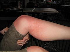 Dry skin heat rash