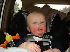 Dry skin on kids faces