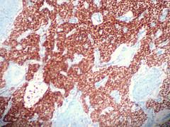Dysfunctional uterine bleeding