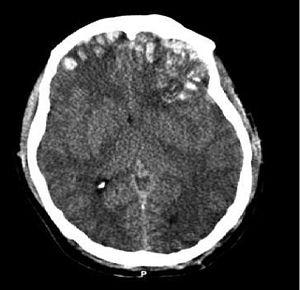 Dystonia brain surgery