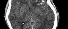 Dystonia brain surgery