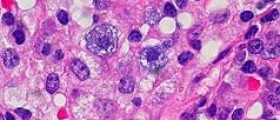 Early Signs and symptoms of Oral cancer