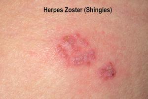 Easy ways to prevent genital herpes