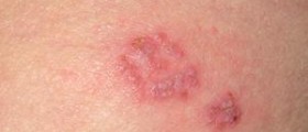 Easy ways to prevent genital herpes