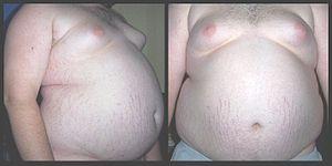 Eating disorder - Obesity