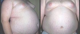 Eating disorder - Obesity
