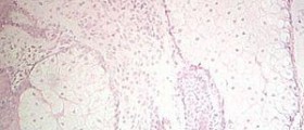 Ectodermal dysplasia symptoms