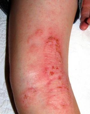 Eczema and food allergies
