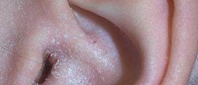 Eczema cure in children