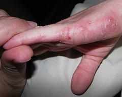 Eczema cured by homeopathic