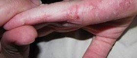 Eczema cured by homeopathic
