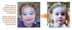 Eczema cures for children
