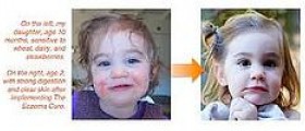 Eczema cures for children
