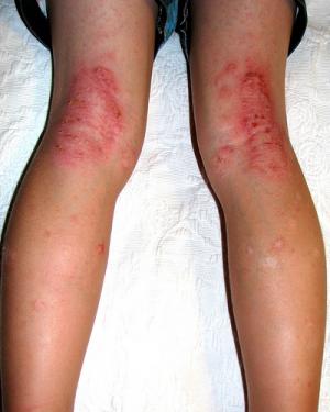 Eczema on feet