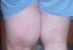Edema symptoms facts