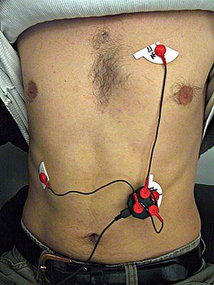 Electrocardiogram stress test