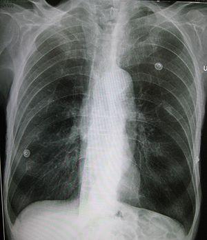 Emphysema and COPD: Problem with collapsed lung 