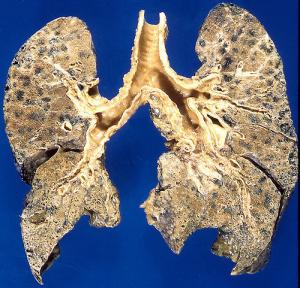 Emphysema causes and treatment