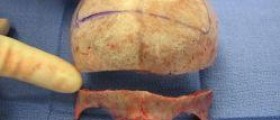 Encephalitis epidemic treatment