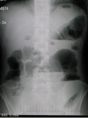 End stage of bowel cancer