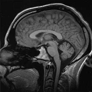 End stage of brain cancer