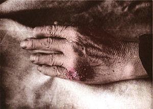 End stage of lupus symptoms