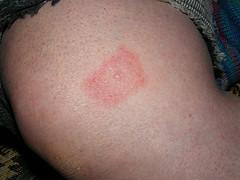 End stage of lyme disease