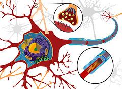 End stage of motor neurone disease
