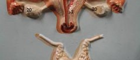 Endocrine benign tumors