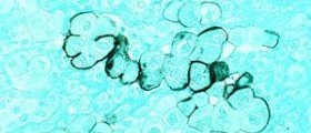 Endocrine system - Pancreas tumor