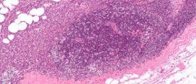 Endocrine therapy for breast cancer
