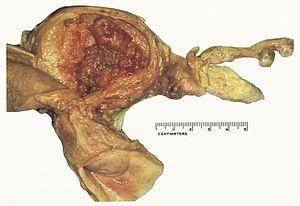 Endometrial ablation procedure