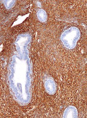Endometrial build up: Endometrial cyst burst