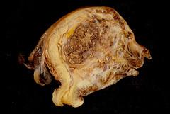 Endometrial cancer facts