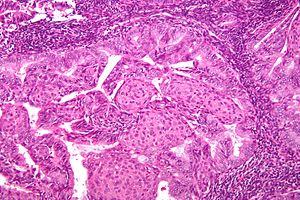 Endometrial cancer symptoms