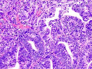 Endometrial carcinoma stages