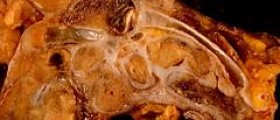 Endometrial carcinoma symptoms