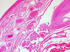 Endometrial complex: Ovarian cyst