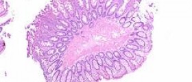 Endometrial polyp facts
