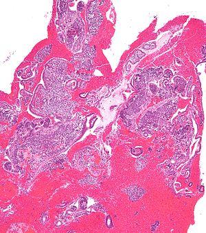 Endometrial resection recovery