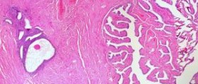 Endometriosis after hysterectomy
