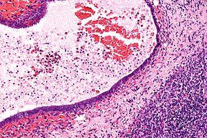 Endometriosis cancer risk