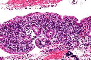 Endometriosis diagnosis facts